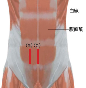 カテーテル留置術アプローチ方法