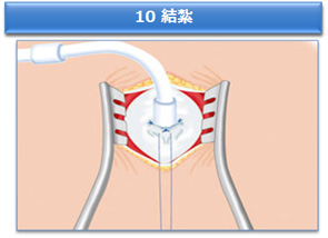 10 結紮