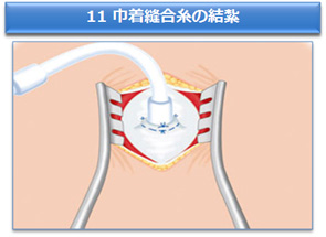 11 巾着縫合糸を結紮