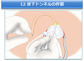 12 皮下トンネルの作製