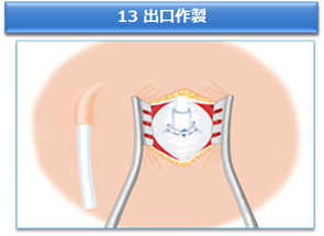 13 出口作製
