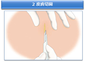 2 皮膚切断