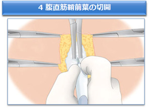 4 腹直筋鞘前葉の切断