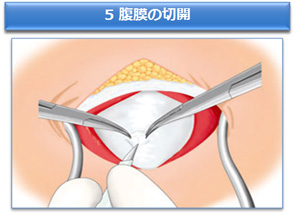 5 腹膜の切開