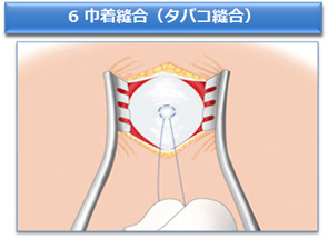 6 巾着縫合（タバコ縫合）