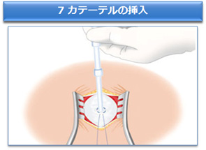 7 カテーテルの挿入