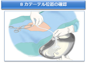 8 カテーテル位置の確認