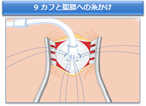 9 カフと腹膜への糸かけ