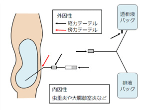 透析 と は 腹膜 腹膜透析(PD)